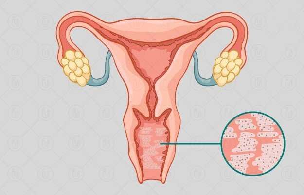 Vajinada Kaşıntı şişlik Yanma Nedir 